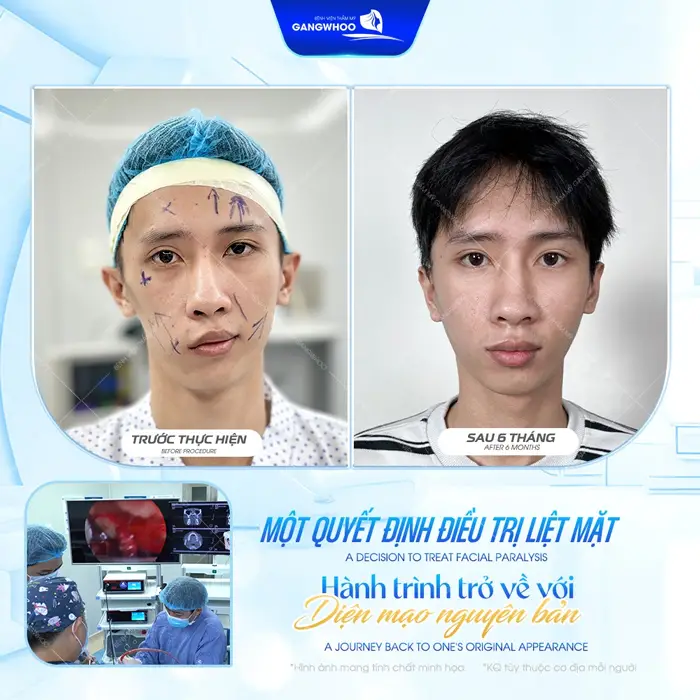 1 quyết định điều trị liệt mặt hành trình trở về với diện mạo nguyên bản sau 1 tháng đã hoàn toàn khác biệt