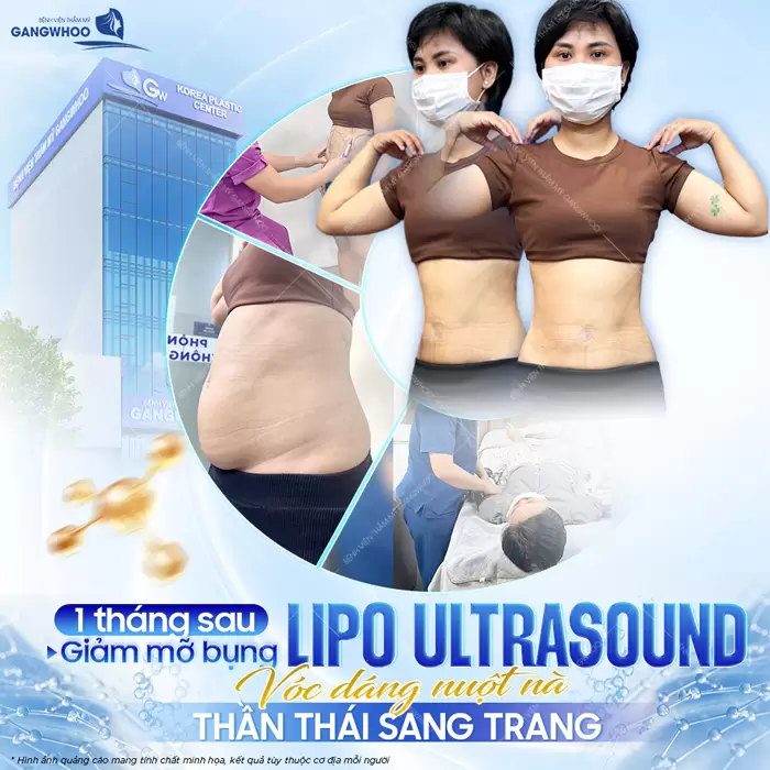 Sau 1 tháng giảm mỡ bụng (Lipo Ultrasound) vóc dáng đẹp nuột nà chuẩn thần thái sau phẫu thuật