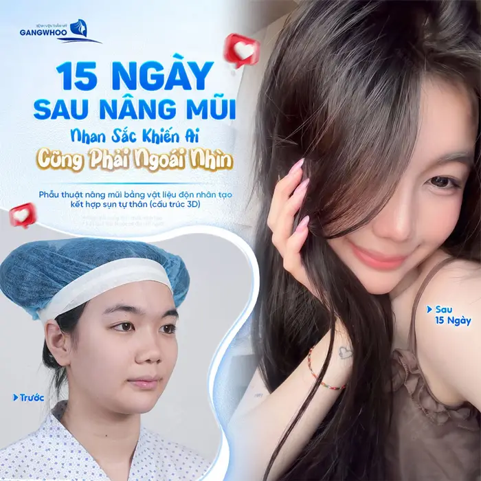 15 ngày nâng mũi bọc sụn nhan sắc từ mờ nhạt đến có điểm nhấn với nhan sắc đầy ấn tượng và tràn đầy rạng rỡ