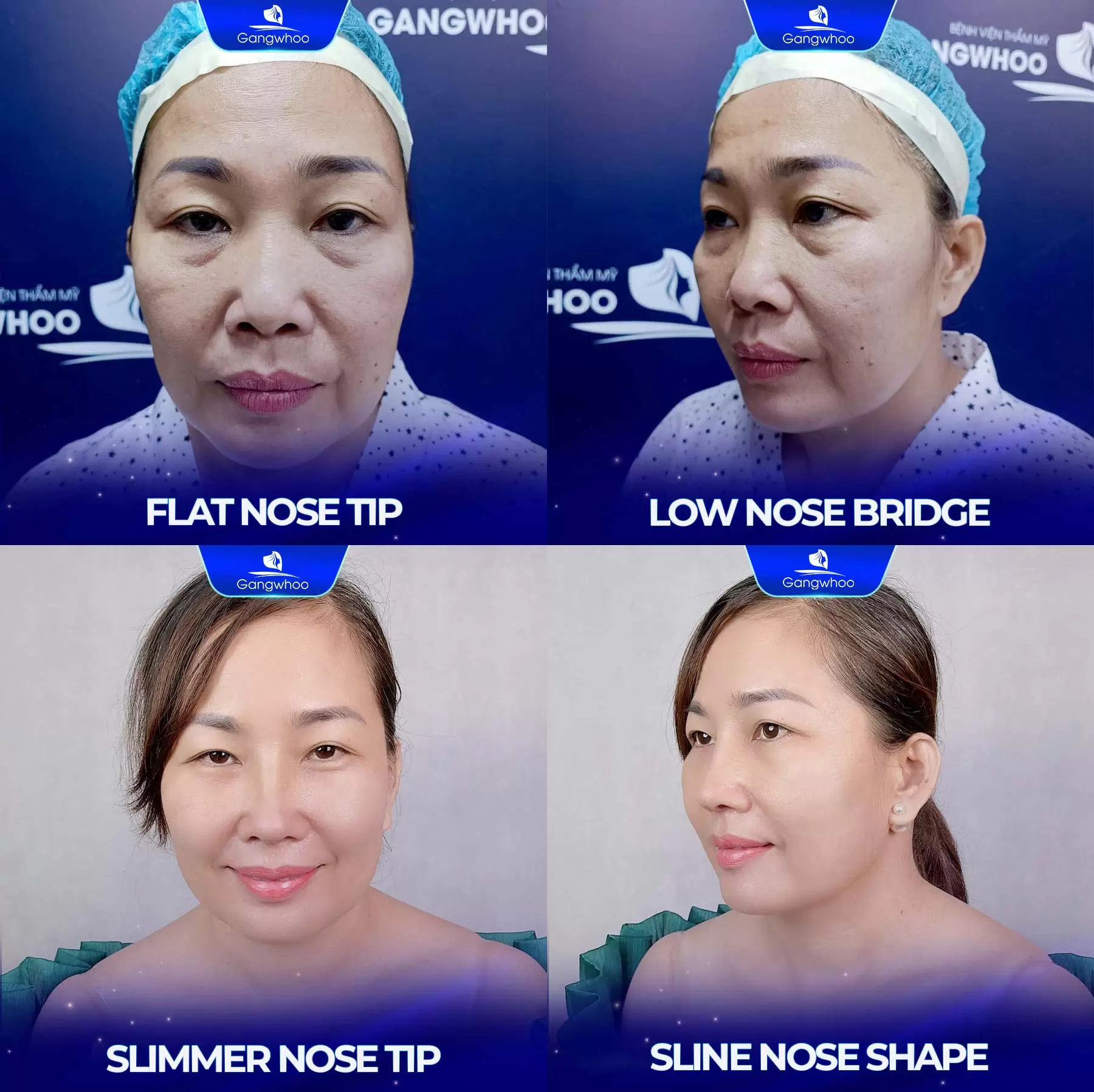 Nanoform Rhinoplasty - Becoming The Center Of Attention 11 19