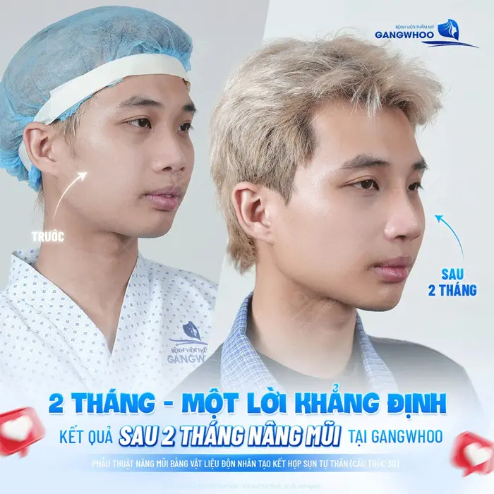 2 tháng một lời khẳng định kết quả sau 2 tháng nâng mũi tại BVTM Gangwhoo
