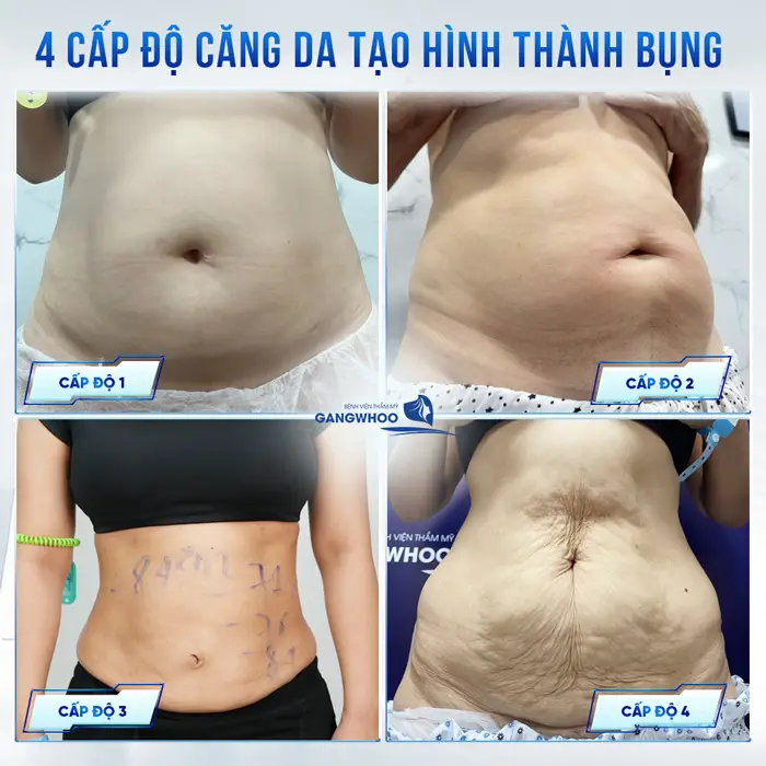 Căng Da Bụng Là Gì? Trường Hợp Nào Nên Và Không Nên Thực Hiện 3 Căng Da Bụng Là Gì? Trường Hợp Nào Nên Và Không Nên Thực Hiện