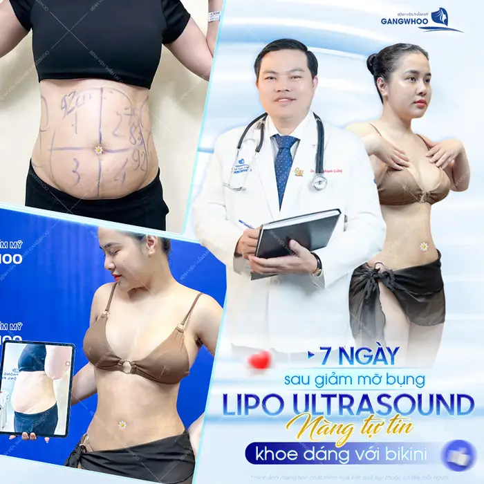 7 ngày giảm mỡ bụng (Lipo Ultrasound) nàng tự tin khoe dáng với bikini 