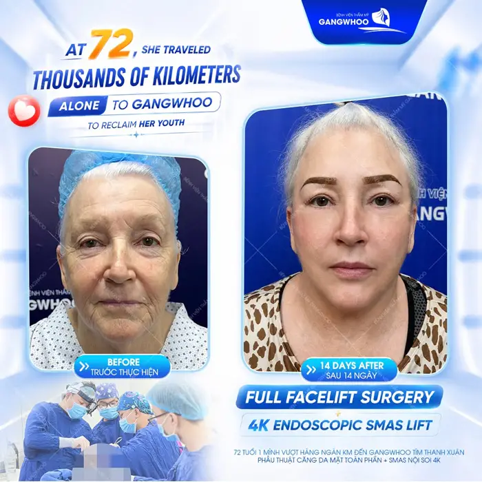 Khách hàng 72 tuổi vượt ngàn đường xa đến Gangwhoo để trùng tu nhan sắc và kết quả quá trẻ đẹp