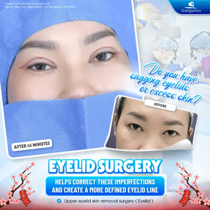 Korean Incisional Blepharoplasty – Transform Yourself Into An Idol Today