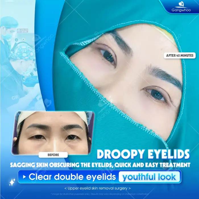 Korean Incisional Blepharoplasty – Transform Yourself Into An Idol Today