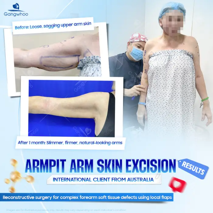 arm liposuction