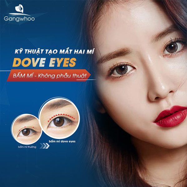 Bấm Mí Dove Eyes - Sở hữu ngay mắt bồ câu