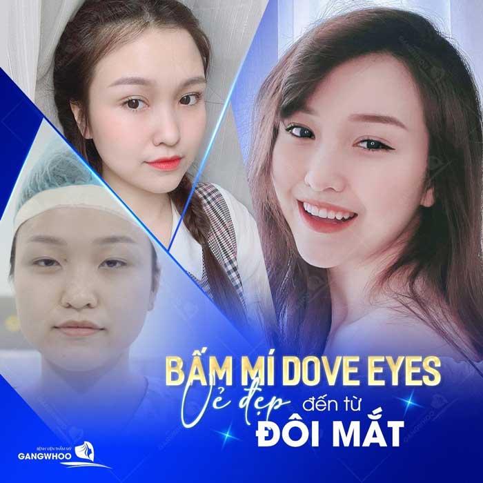 Bấm Mí Dove Eyes cải thiện vận mệnh