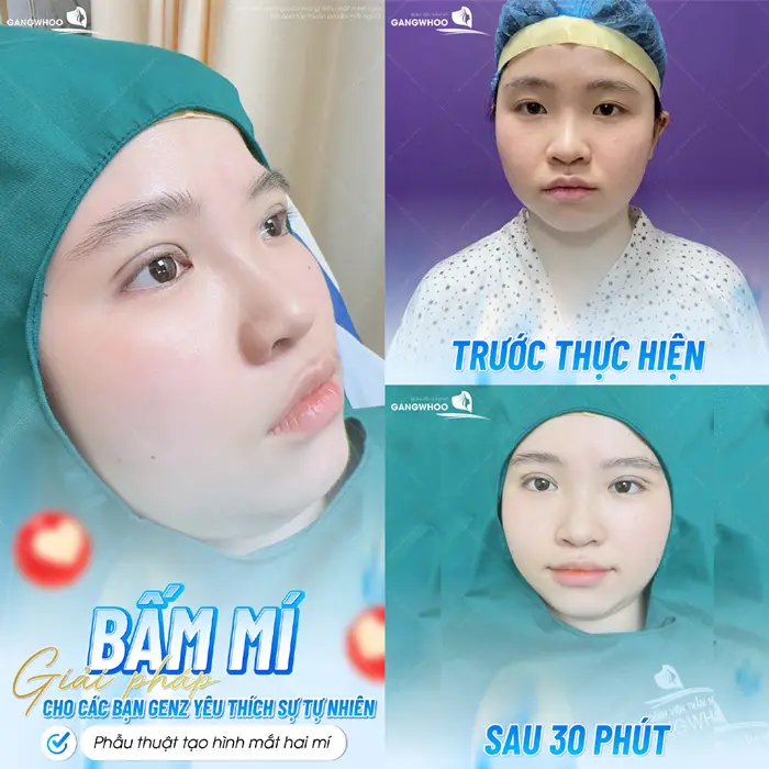 Bấm mí giải pháp cho các bạn GenZ yêu thích sự tự nhiên và mềm mại với đường mí sắc nét và chân thực