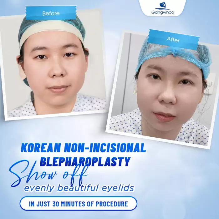 Korean Non-incisional Blepharoplasty - Have Korean Beauty Of A Star 8 bam mi han quoc 4 1