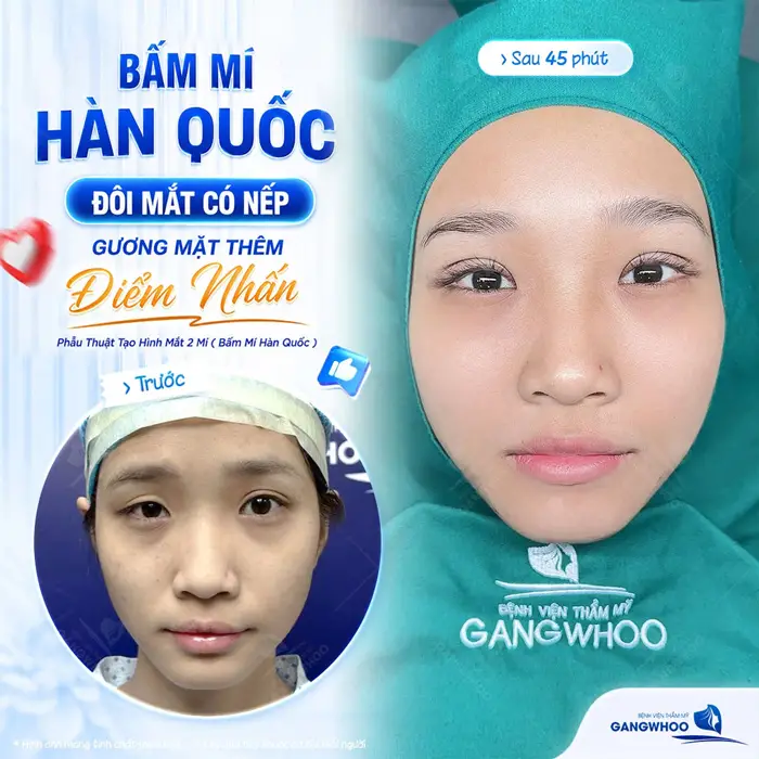 Bấm mí Hàn Quốc đôi mắt đẹp có nếp gương mặt thêm điểm nhấn diện mạo thêm tươi xinh