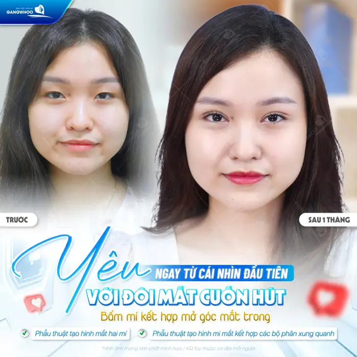 Bấm mí kết hợp mở rộng góc mắt trong sau 1 tháng đã tự tin sở hữu đôi mắt cuốn hút