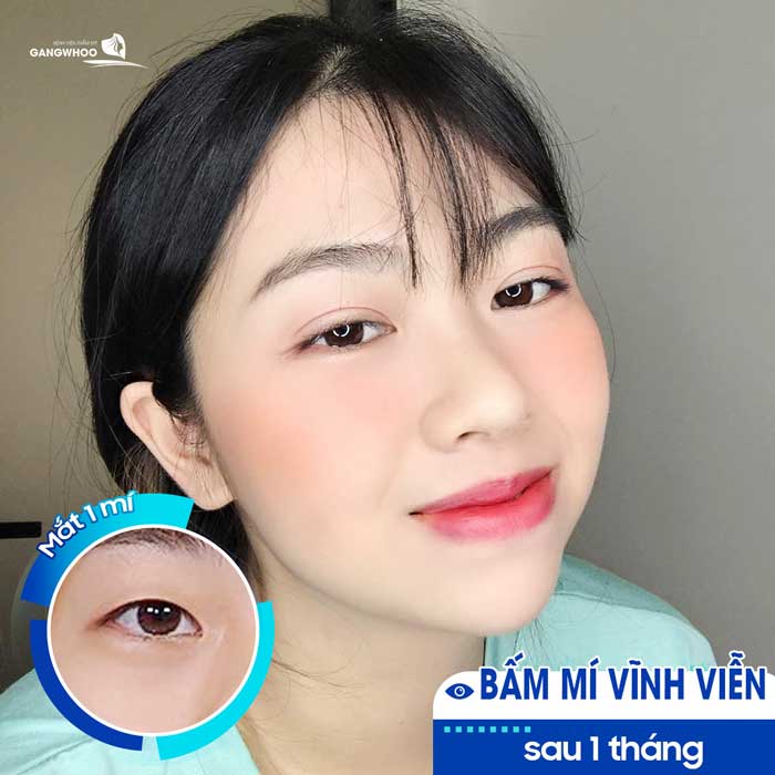 Bấm Mí - Cho Đôi Mắt To Tròn Đầy Cuốn Hút 3 Bấm mí - tự tin khoe đôi mắt đẹp dài lâu và bền đẹp theo thời gian