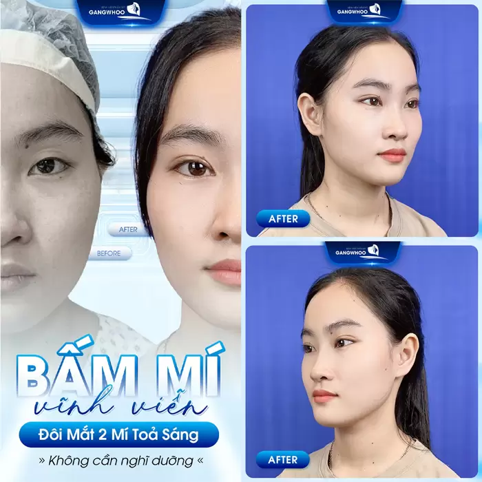 Bấm Mí - Cho Đôi Mắt To Tròn Đầy Cuốn Hút 1 Bấm mí - giải pháp hoàn hảo cho đôi mắt đẹp tỏa sáng mà không cần nghỉ dưỡng dài lâu