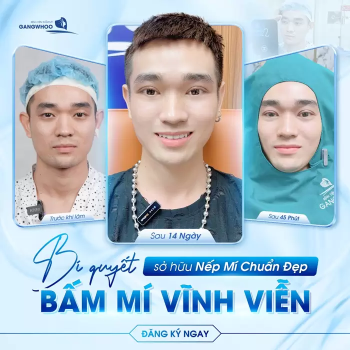 Bấm Mí - Cho Đôi Mắt To Tròn Đầy Cuốn Hút 5 Lựa chọn bấm mí - chàng trai tự tin sở hữu đôi mắt chuẩn đẹp bền lâu