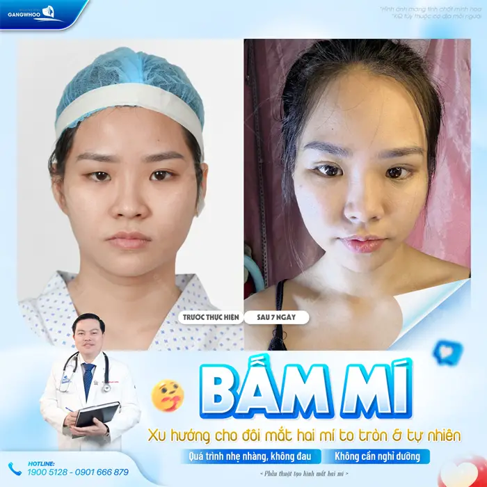 Bấm mí xu hướng cho đôi mắt 2 mí to tròn và tự nhiên quá trình nhẹ nhàng, không đau, không cần nghỉ dưỡng