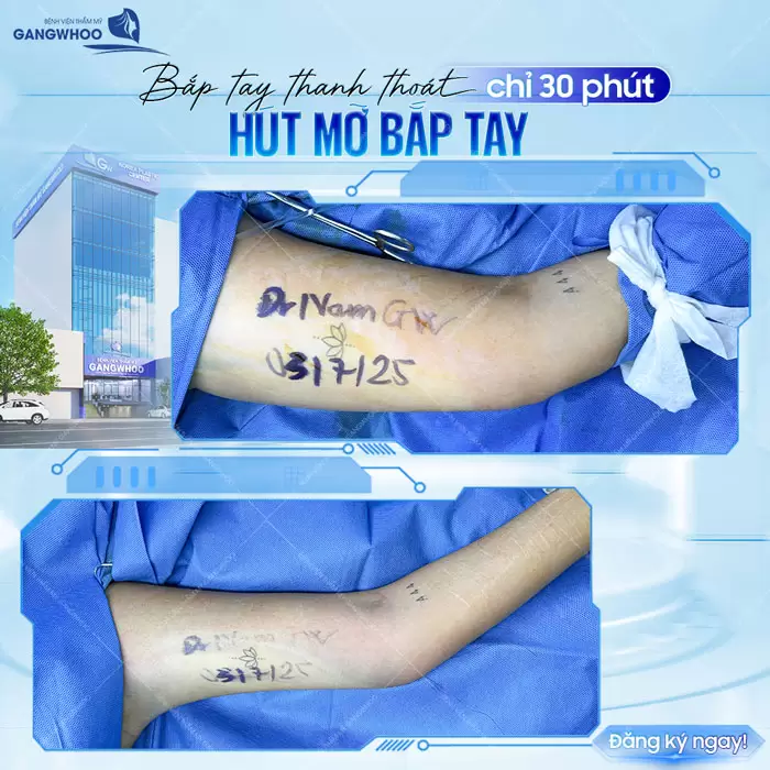 Hút Mỡ Cánh Tay Giúp Lấy Lại Đôi Tay Thon Gọn Nhanh Chóng 27 Bắp tay thanh thoát chỉ sau 30 phút thực hiện với sự hỗ trợ của công nghệ cao