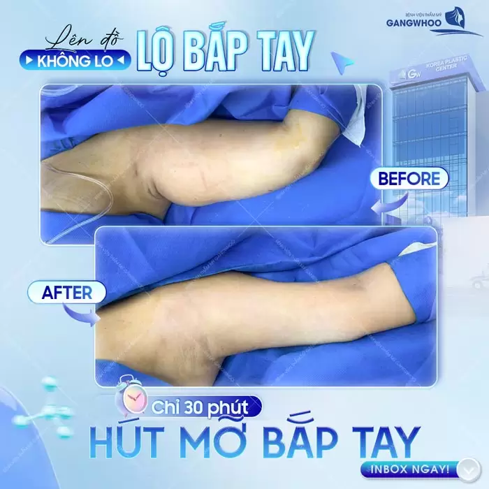 Hút Mỡ Cánh Tay Giúp Lấy Lại Đôi Tay Thon Gọn Nhanh Chóng 9 Hút mỡ bắp tay lên đồ diện đầm dây tự tin với cánh tay thon gọn