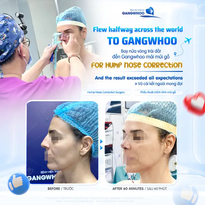Bay nửa vòng trái đất đến Gangwhoo mài gồ xương mũi kết quả sau 60 phút đã đẹp xuất sắc