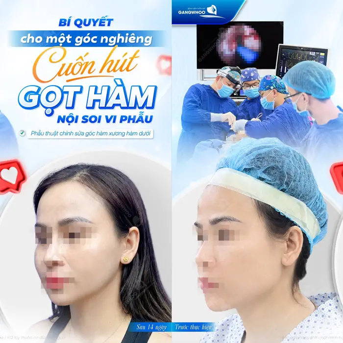 Phẫu Thuật Gọt Hàm V-Line Vi Phẫu Là Gì? Có Nguy Hiểm Không? 1 Bí quyết cho 1 góc nghiêng cuốn hút đó là thực hiên gọt hàm nội soi vi phẫu tại bệnh viện thẩm mỹ Gangwhoo