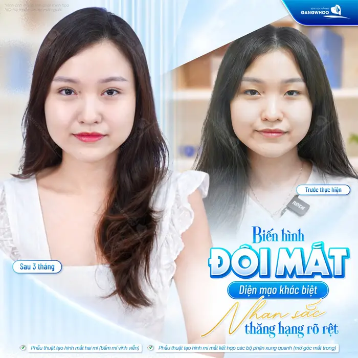 Cắt Mí Hàn Quốc Cho Bạn Đôi Mắt 2 Mí Đẹp Chuẩn "Sao Hàn" 2 Biến hình đôi mắt nhan sắc thăng hạng sau thực hiện ngày càng rạng rỡ và bừng sức sống