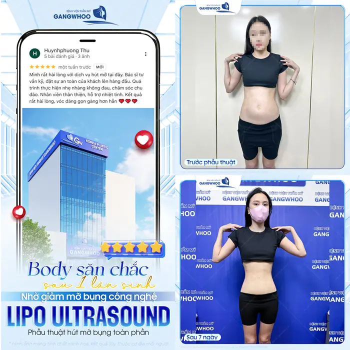 body san chac sau 1 lan sinh nho giam mo cong nghe lipo ultrasound hien dai