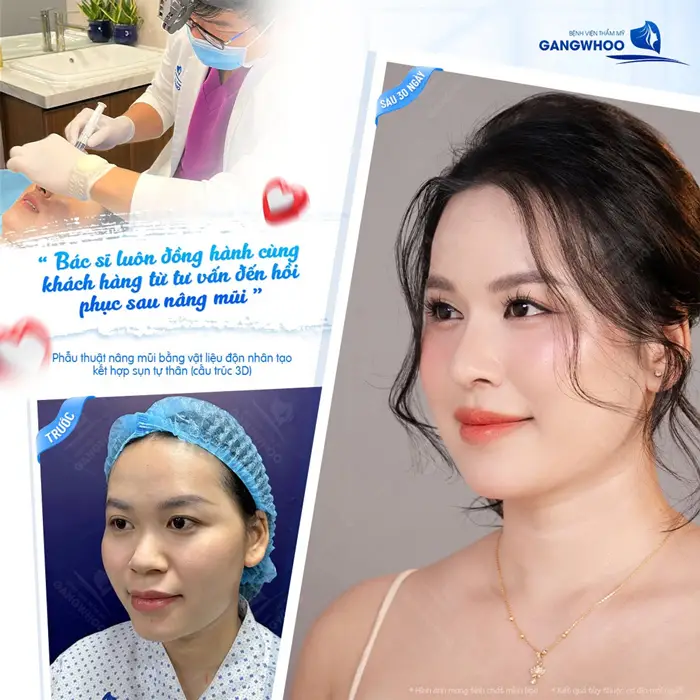 Sau 30 ngày nâng mũi diện mạo thăng hạng nhan sắc thêm cuốn hút và đầy ấn tượng