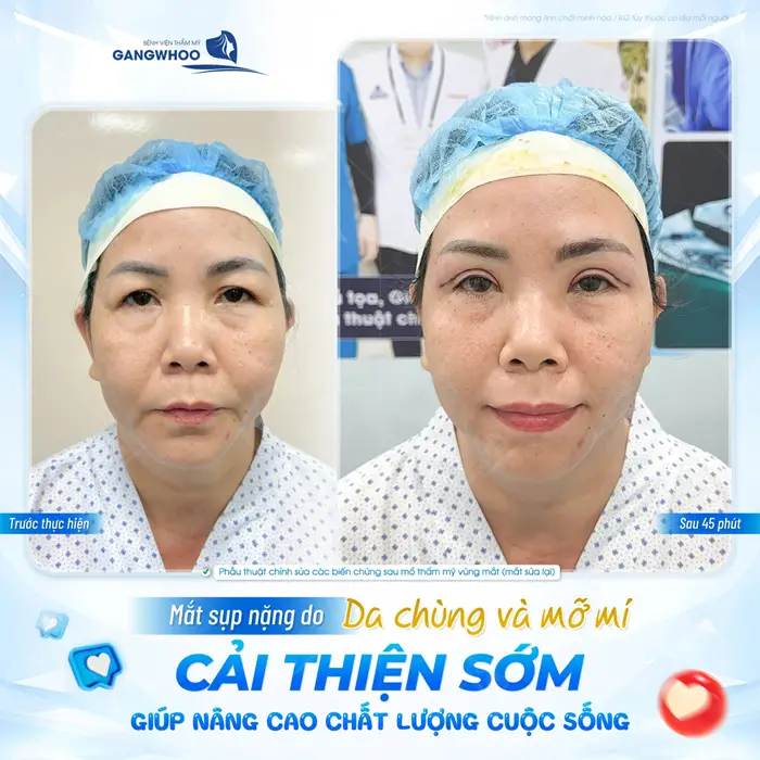 Mắt sụp mí nặng do da chùng và mỡ ắmt cải thiện sớm giúp nâng cao chất lượng cuộc sống