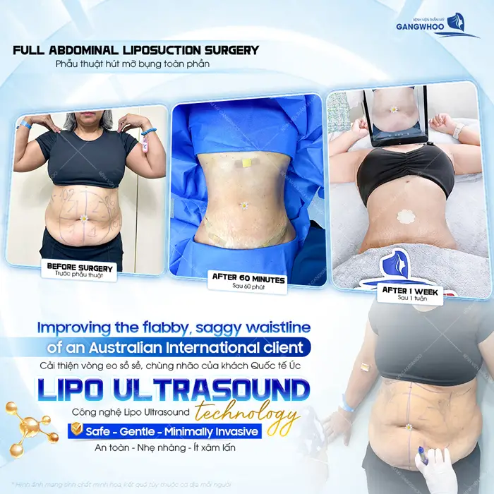 Cải thiện vòng eo sồ sề và chũng nhão của khách Quốc tế Úc với công nghệ Lipo ULtrasound hiện đại 