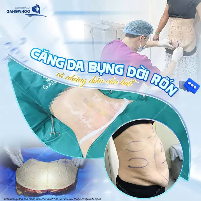 Căng Da Bụng Là Gì? Trường Hợp Nào Nên Và Không Nên Thực Hiện 1 Căng da bụng dời rốn sắc vóc đẹp toản diện tự tin siêu cuốn hút
