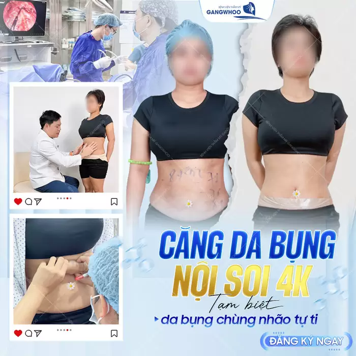 Căng Da Bụng Là Gì? Trường Hợp Nào Nên Và Không Nên Thực Hiện 11 Căng da bụng nội soi 4K tạm biệt da bụng chùng nhão tự ti
