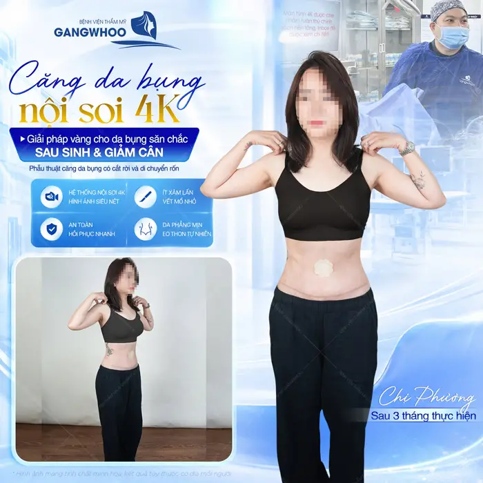 Phẫu Thuật Căng Da Bụng Là Gì? Trường Hợp Nào Nên Và Không Nên Thực Hiện 4 Căng da bụng nội soi 4K giải pháp vàng cho bụng săn chắc sau sinh và giảm cân