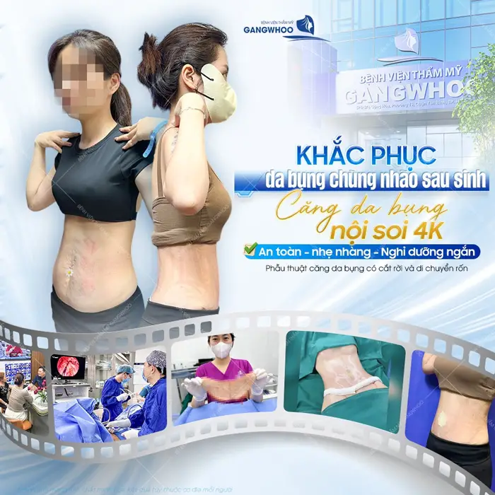 Khắc phục da bụng chùng nhão sau sinh căng da bụng nội soi 4K an toàn, nhẹ nhàng và nghĩ dưỡng ngắn