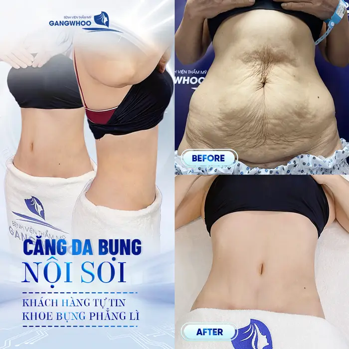 Căng Da Bụng Là Gì? Trường Hợp Nào Nên Và Không Nên Thực Hiện 9 Căng Da Bụng Là Gì? Trường Hợp Nào Nên Và Không Nên Thực Hiện