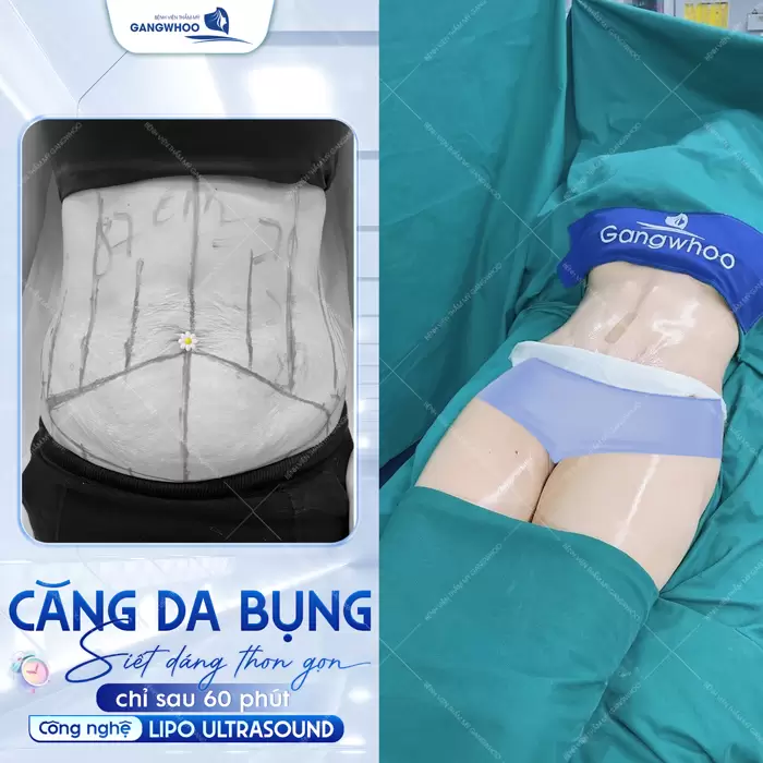 Căng Da Bụng Là Gì? Trường Hợp Nào Nên Và Không Nên Thực Hiện 8 Căng da bụng giải pháp siết dáng eo thon gọn chỉ sau 60 phút thực hiện