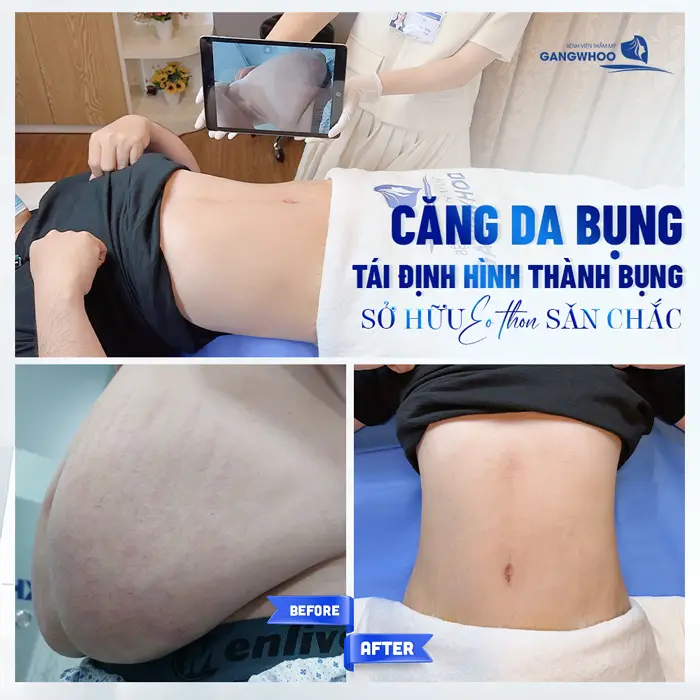 Căng Da Bụng Là Gì? Trường Hợp Nào Nên Và Không Nên Thực Hiện 7 Căng Da Bụng Là Gì? Trường Hợp Nào Nên Và Không Nên Thực Hiện