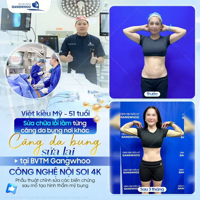 Căng da bụng tại bệnh viện thẩm mỹ Gangwhoo khắc phục biến chứng do căng da bụng hỏng từ nơi khác