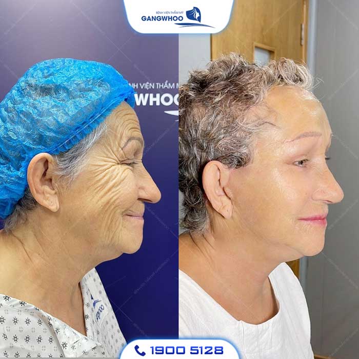 Căng Da Mặt Toàn Phần - Bí Quyết Trẻ Hóa Không Để Lại Sẹo 12 Khách hàng căng da mặt tại Gangwhoo