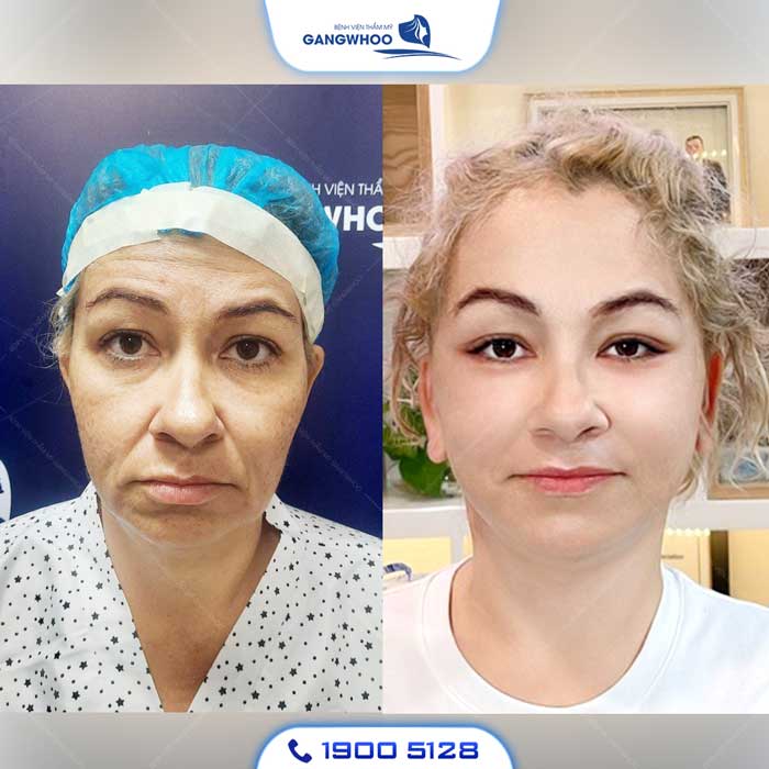 Căng Da Mặt Toàn Phần - Bí Quyết Trẻ Hóa Không Để Lại Sẹo 13 Khách hàng căng da mặt tại Gangwhoo