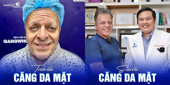 Căng Da Mặt Toàn Phần - Bí Quyết Trẻ Hóa Không Để Lại Sẹo 32 cang da mat 26