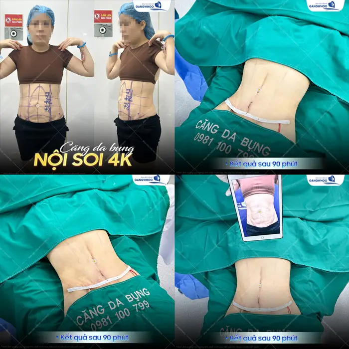 Căng Da Bụng Là Gì? Trường Hợp Nào Nên Và Không Nên Thực Hiện 2 Căng da bụng nội soi 4K kết quả thay đổi sau 90 phút thực hiện