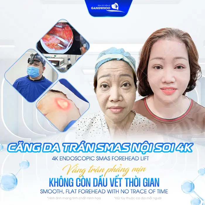 Phẫu Thuật Căng Da Trán không còn vầng trán cao diện mạo trẻ đẹp không còn dấu hiệu lão hóa