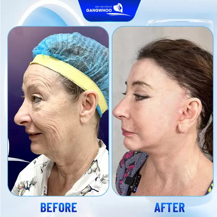 Phẫu Thuật Căng Da Trán Nội Soi 4K - Thổi Bay Nếp Nhăn Trán