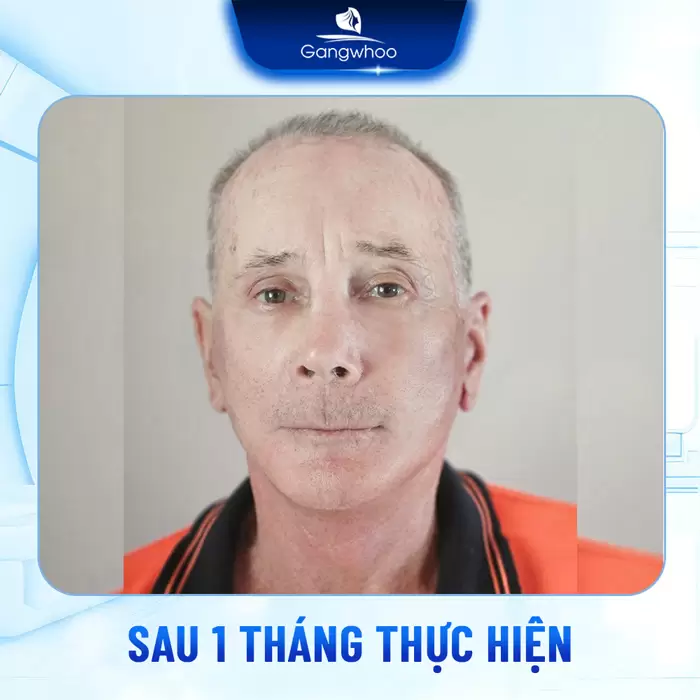 Phẫu Thuật Căng Da Trán Nội Soi 4K - Thổi Bay Nếp Nhăn Trán