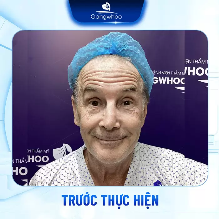 Phẫu Thuật Căng Da Trán Nội Soi 4K - Thổi Bay Nếp Nhăn Trán