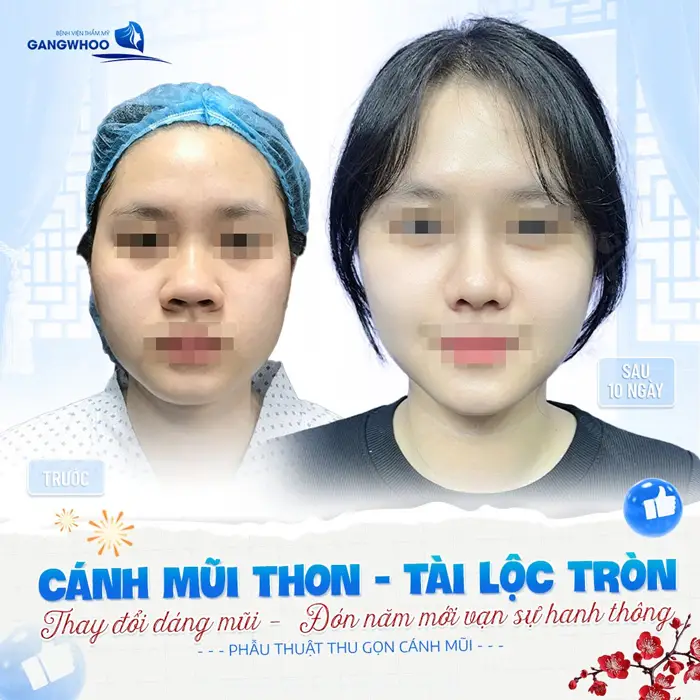 Phẫu Thuật Thu Gọn Cánh Mũi Khắc Phục Mũi To Bè Trở Nên Thon Gọn 5 Cánh mũi thon đẹp - tài lộc tròn đầy thay đổi mũi mới đón năm mới thuận lợi và hanh thông