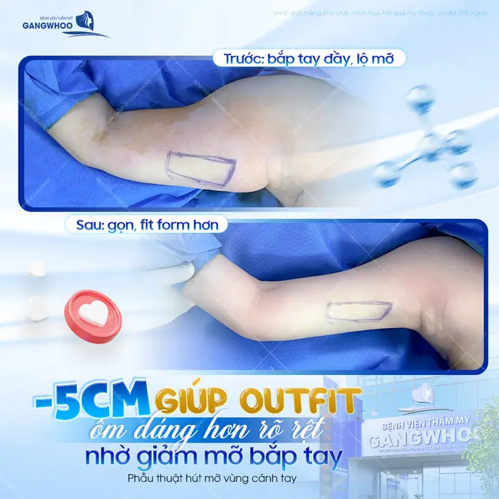 Tạm biệt 5cm mỡ vùng cánh tay nhờ giảm mỡ bắp tay ứng dụng công nghệ hiện đại 