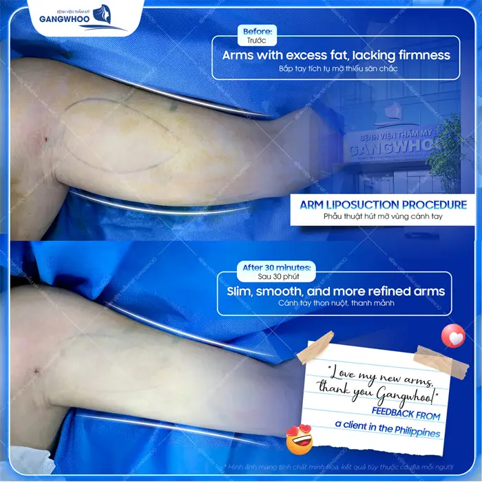 30 phút phẫu thuật hút mỡ cánh tay tự tin khoe đôi tay thon gọn, hài hòa và đẹp đều