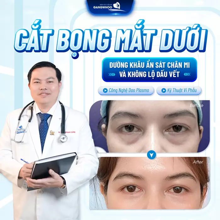 Cắt bọng mắt mi dưới đường khâu ẩn sát chân mi mắt đẹp tươi trẻ không để lại dấu vết